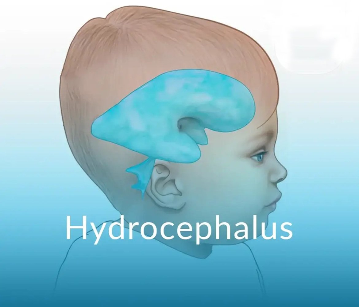 Developmental Delay
